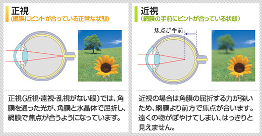 正視／近視