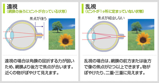 遠視／乱視